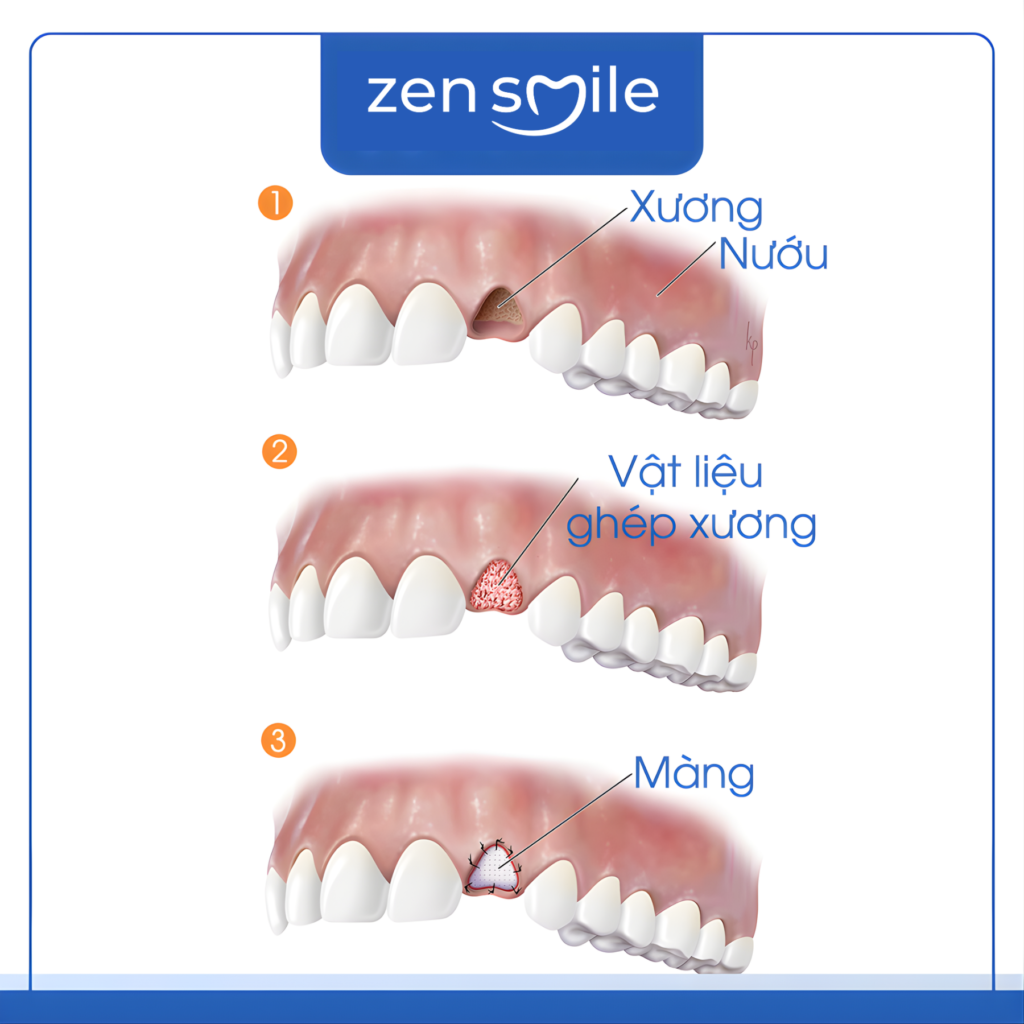 Ghép màng — ảnh 5