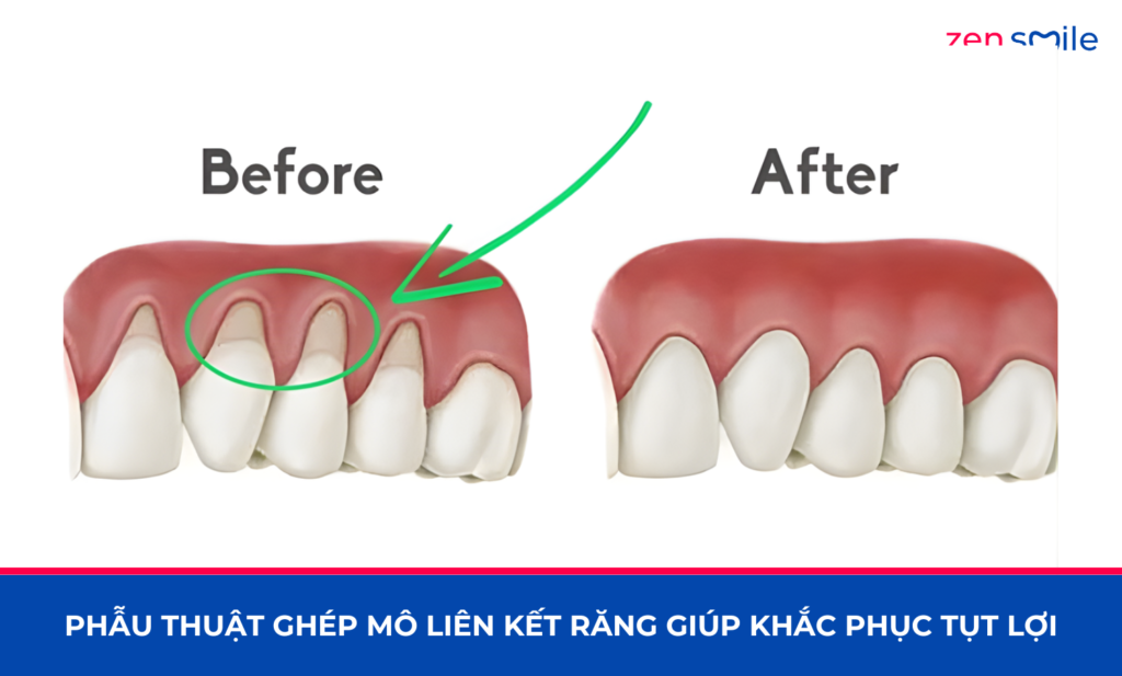 Ghép mô liên kết — ảnh 5