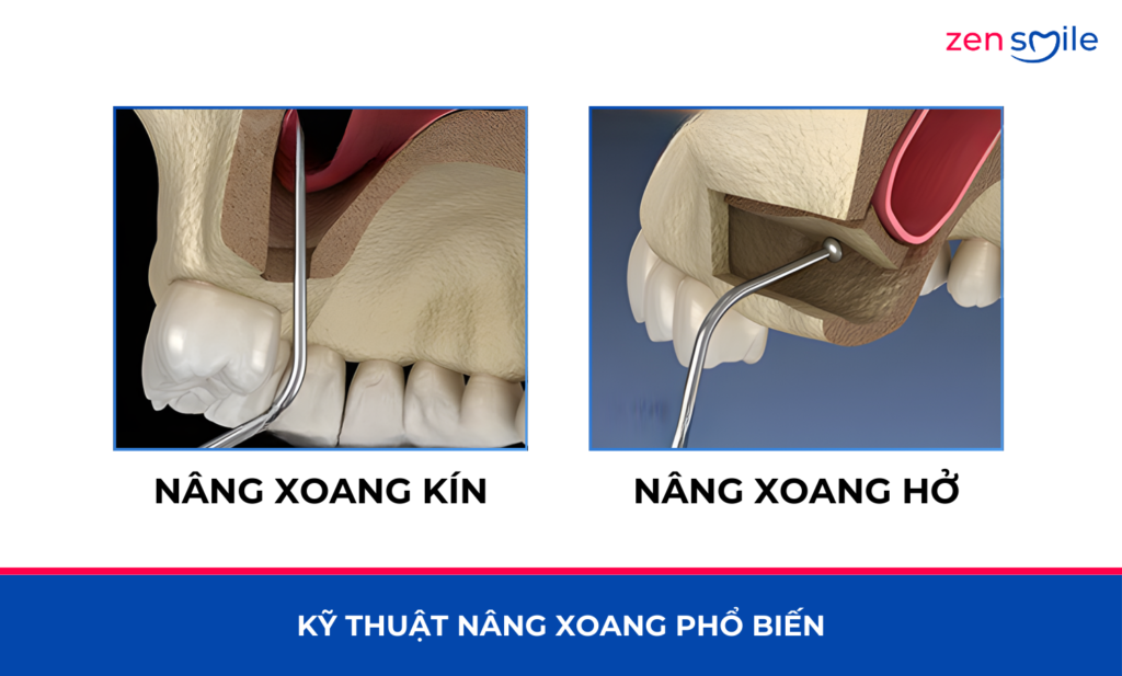 Nâng xoang — ảnh 2