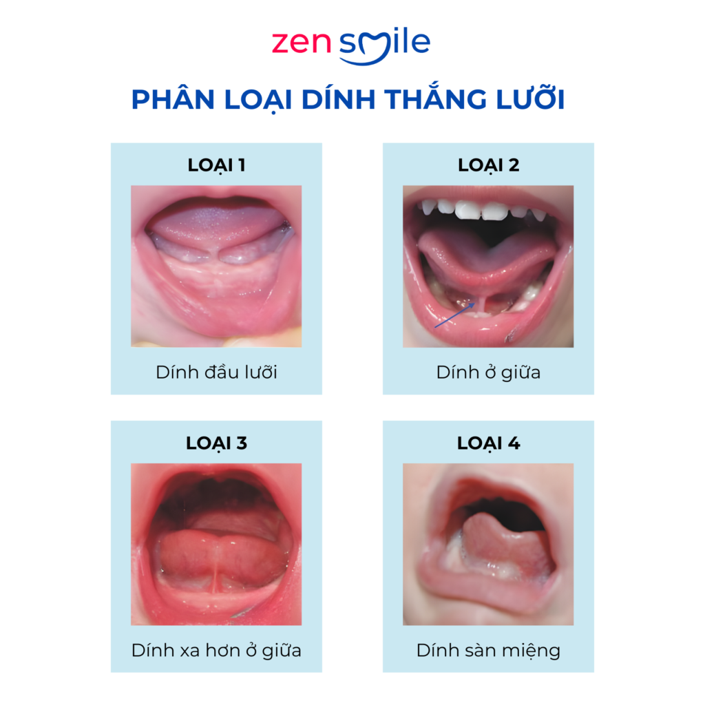 Cắt phanh môi, lưỡi — ảnh 7