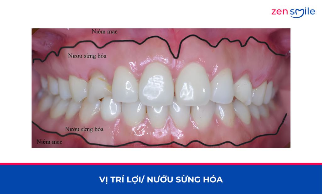 Cắt lợi sừng hoá — ảnh 2