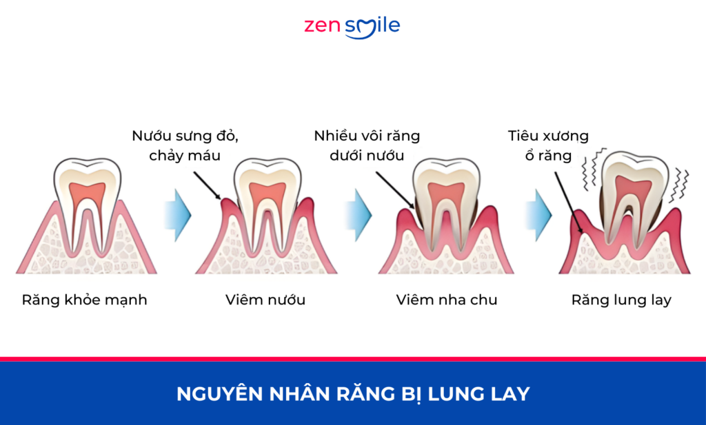 Nhổ răng lung lay — ảnh 2