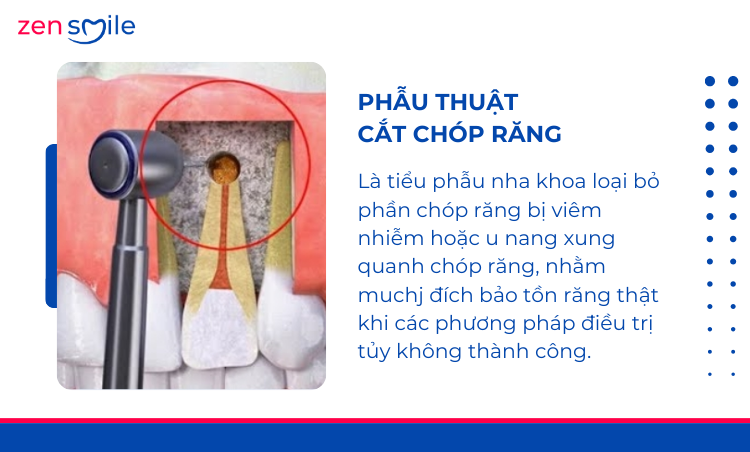 Phẫu thuật cắt chóp răng — ảnh 2