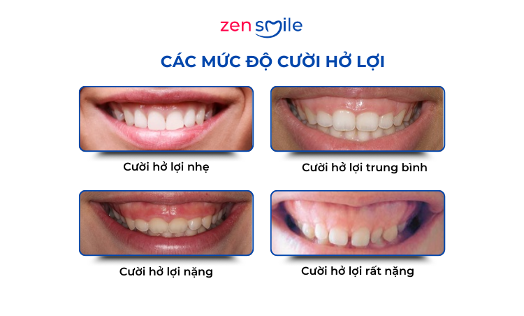 Điều trị hở lợi độ 1-3 — ảnh 3
