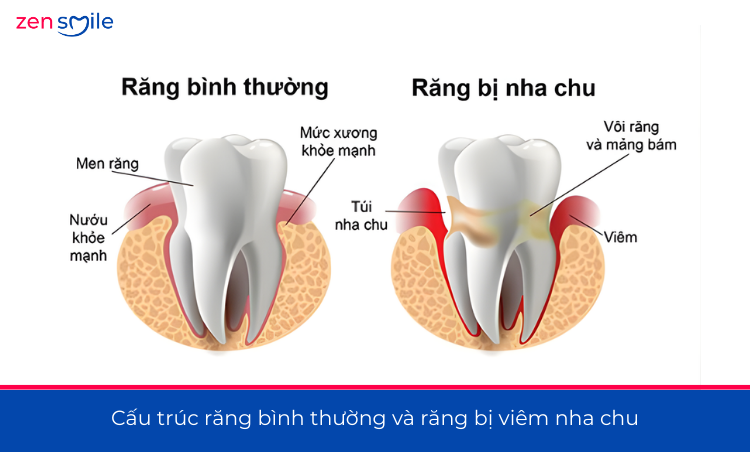 Điều trị nha chu không lật vạt — ảnh 2