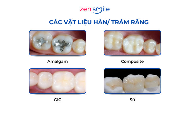 Hàn răng vĩnh viễn (độ 1 – độ 3) — ảnh 4