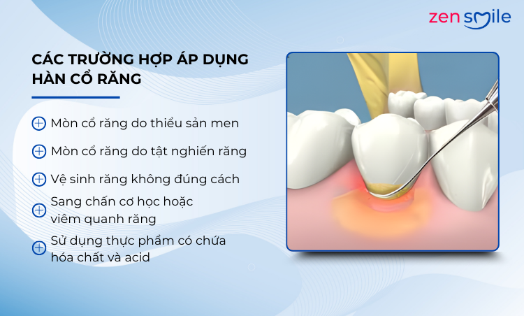 Hàn cổ răng — ảnh 3