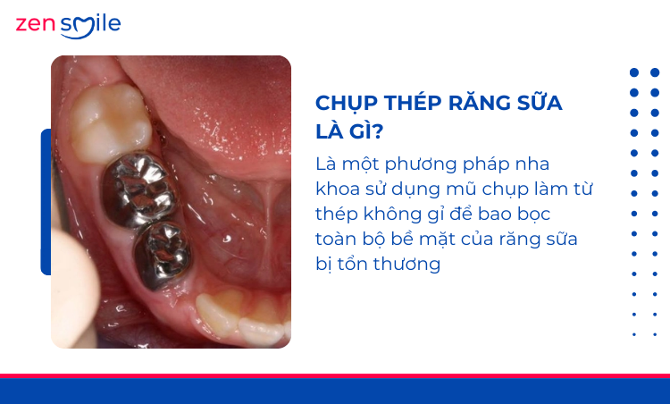 Chụp thép bảo vệ răng sữa trẻ em — ảnh 2