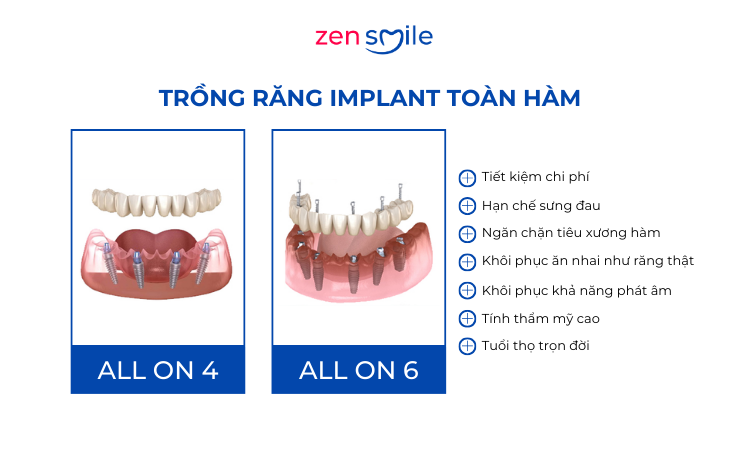 Implant All-on Osstem — ảnh 6