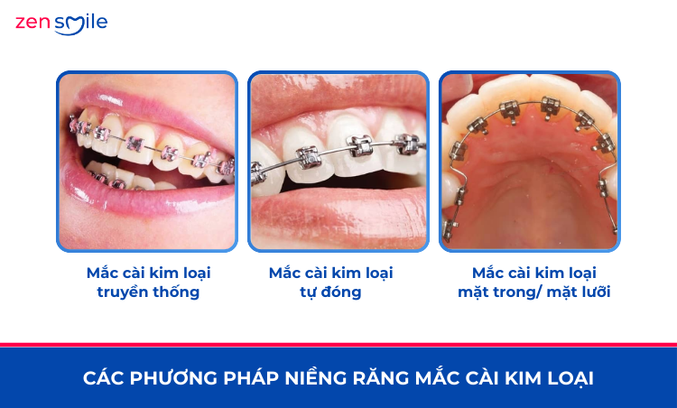 Mắc cài kim loại truyền thống — ảnh 2