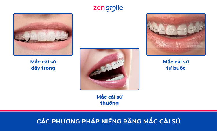 Mắc cài sứ truyền thống — ảnh 2