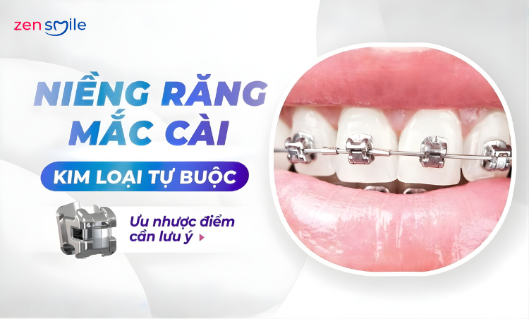 Mắc cài Smart kim loại — ảnh 2
