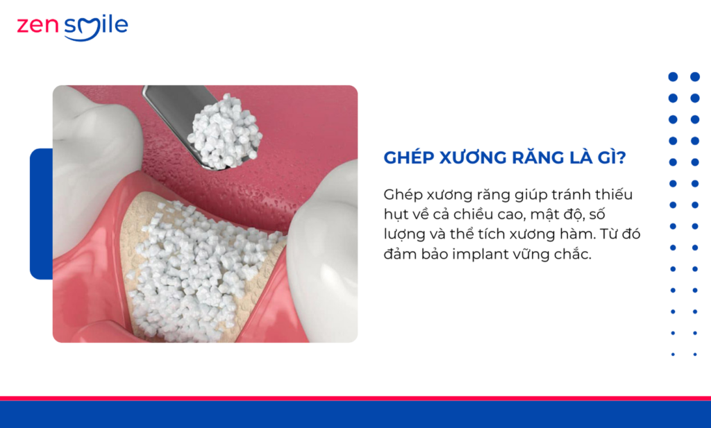 Ghép xương — ảnh 7