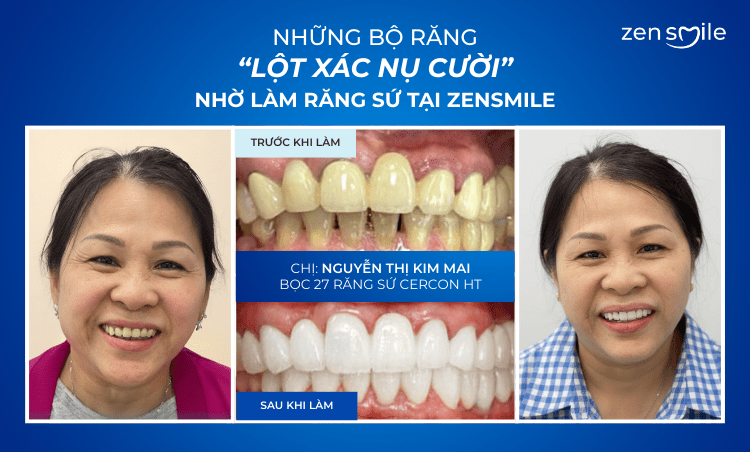 Ca trước – sau tại Nha khoa Zensmile 5