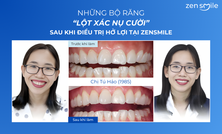 Ca trước – sau tại Nha khoa Zensmile 6