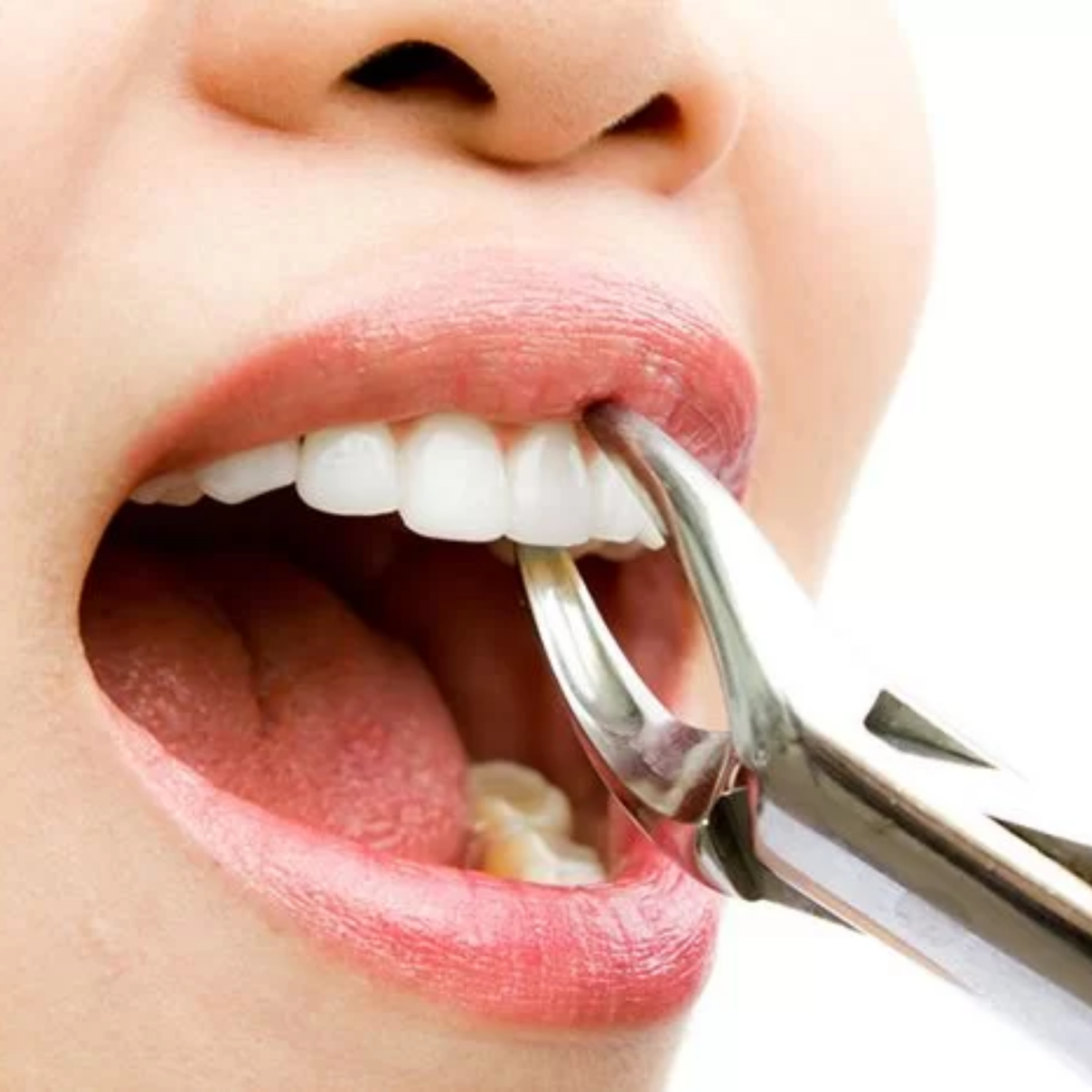 Nhổ răng người lớn — ảnh 1