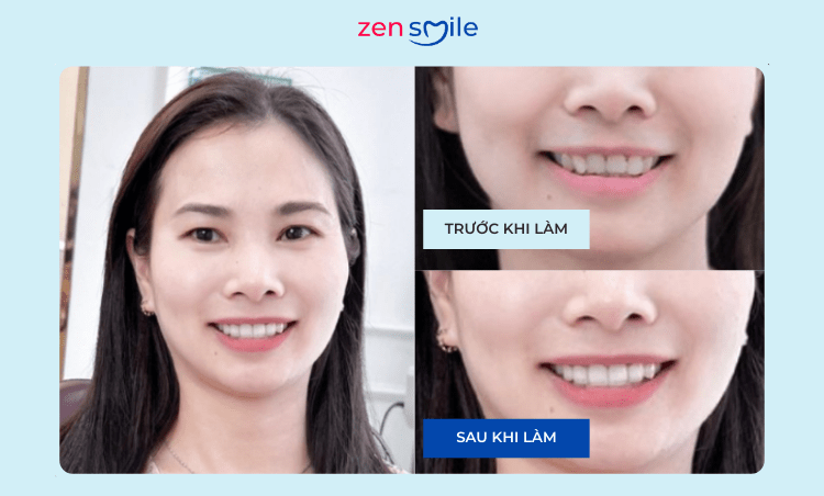 Răng sứ Nacera Q3 — ảnh 5