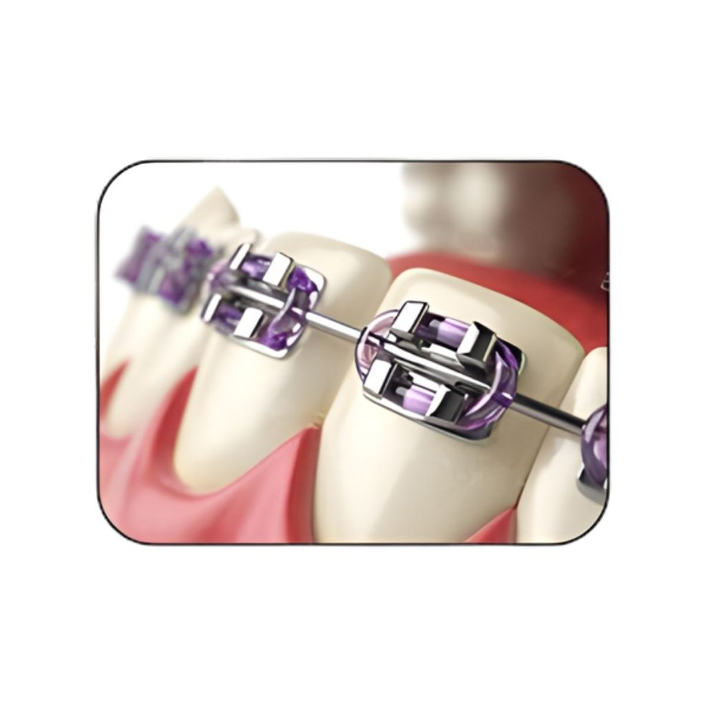 Mắc cài kim loại truyền thống — ảnh 1