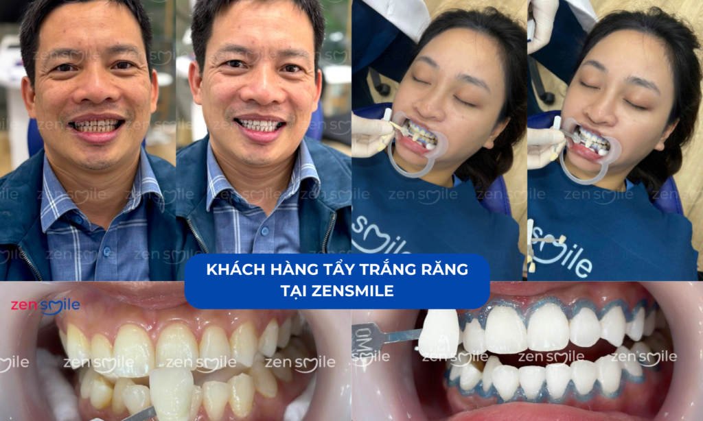 Tẩy trắng răng Nhật Bản — ảnh 4