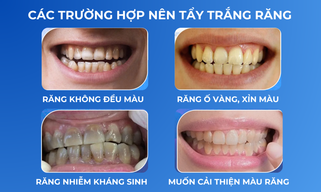 Tẩy trắng răng Nhật Bản — ảnh 5