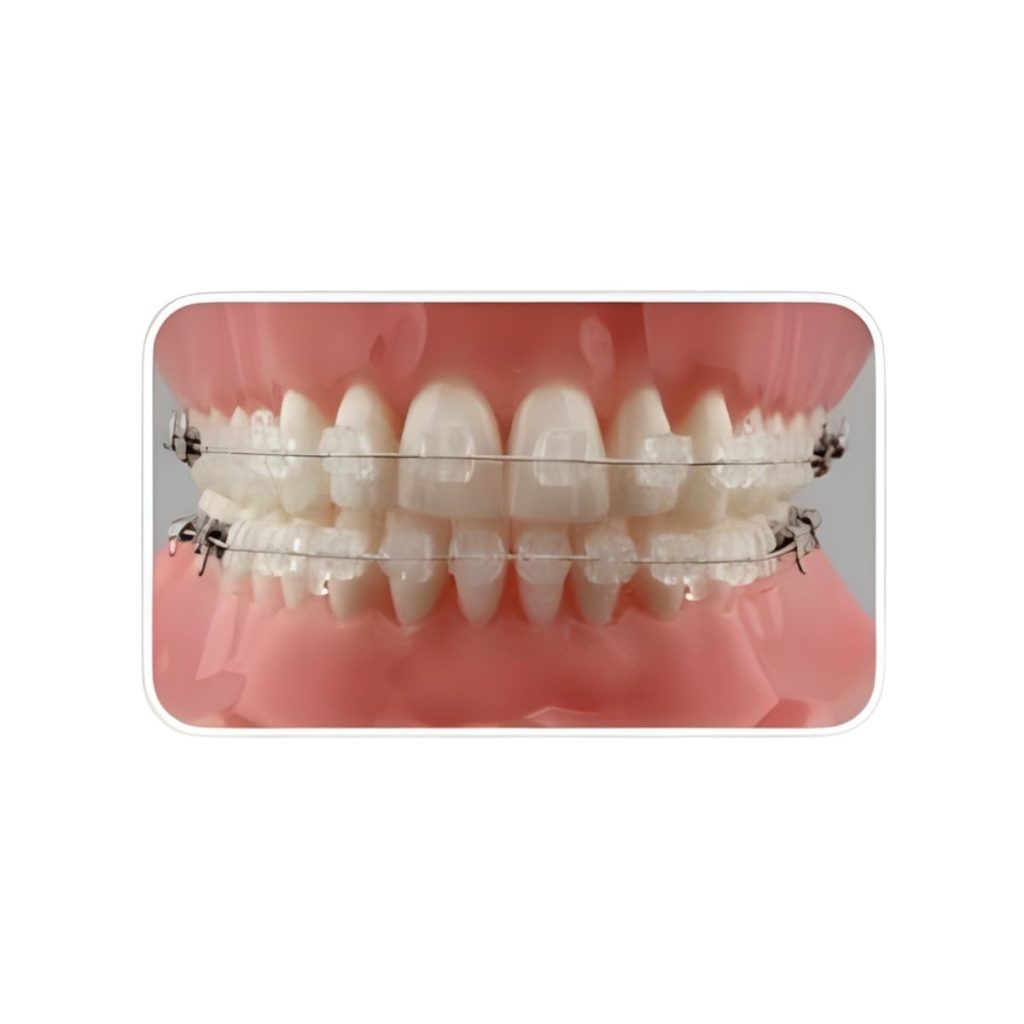 Mắc cài sứ truyền thống — ảnh 1