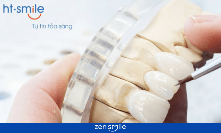 Răng sứ HT-Smile — ảnh 3