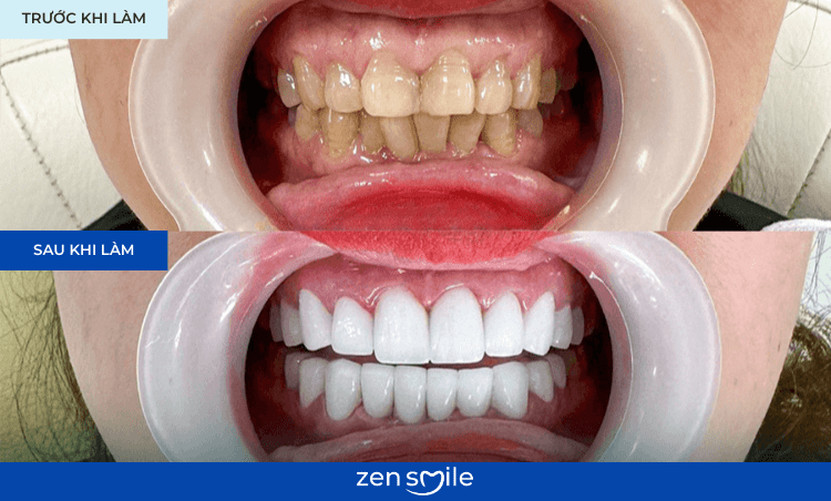 Răng sứ HT-Smile — ảnh 5