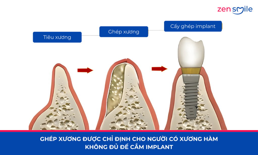 Ghép xương — ảnh 2