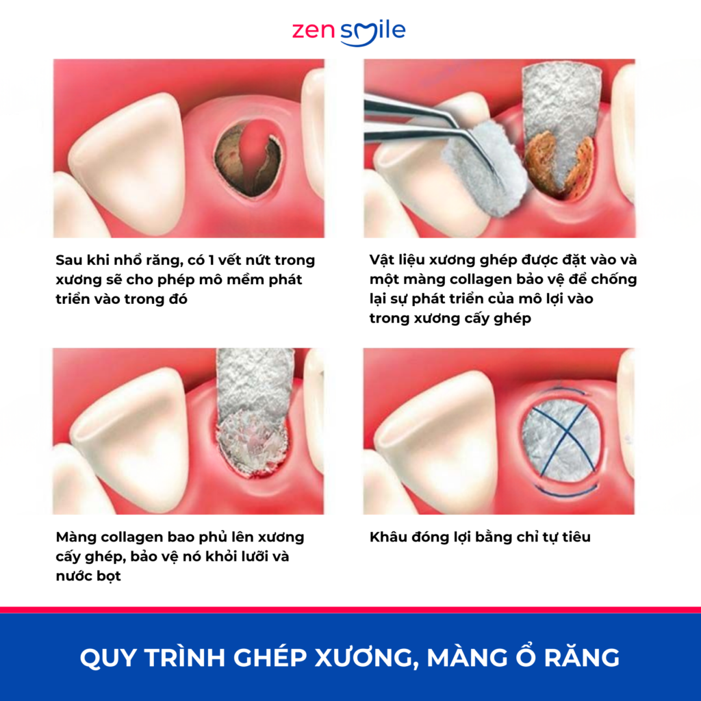 Ghép màng — ảnh 6
