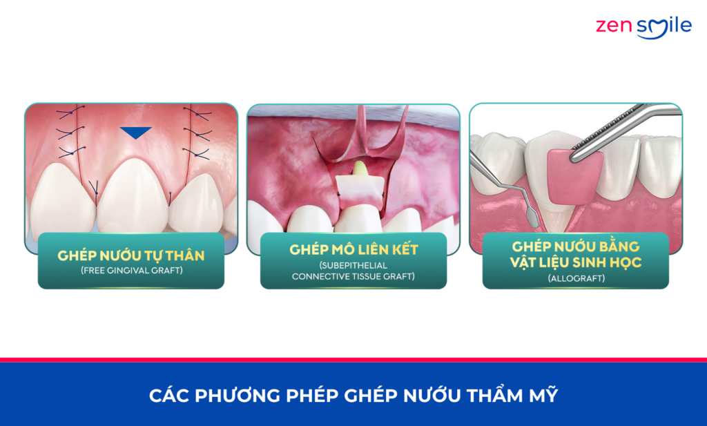 Ghép mô liên kết — ảnh 6