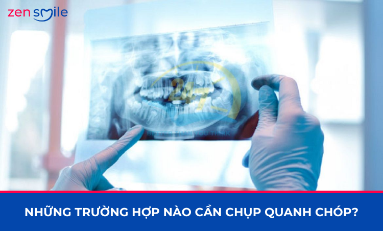 Chụp quanh chóp kỹ thuật số — ảnh 7