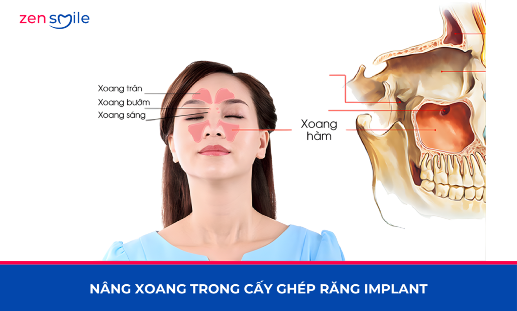 Nâng xoang — ảnh 6