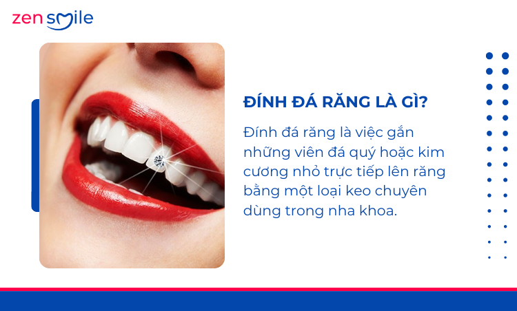 Đính đá nha khoa — ảnh 7