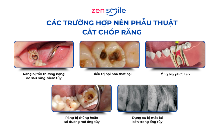 Phẫu thuật cắt chóp răng — ảnh 3