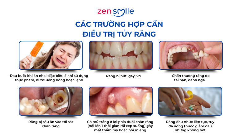 Điều trị tuỷ răng vĩnh viễn 1-4 chân — ảnh 3