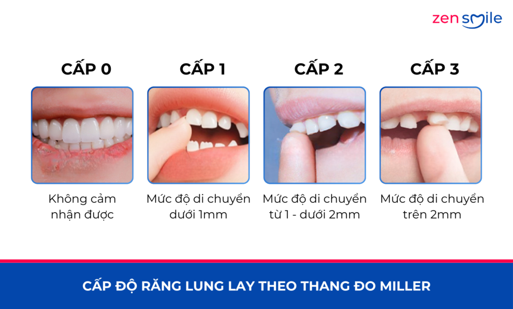 Nhổ răng lung lay — ảnh 3