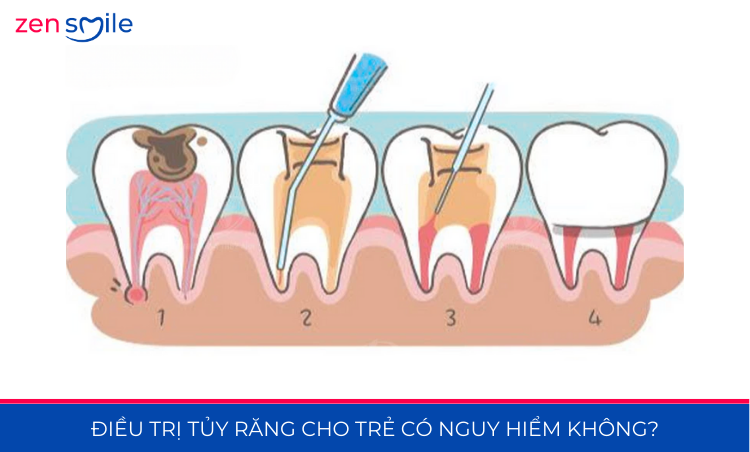 Điều trị tuỷ răng sữa — ảnh 6