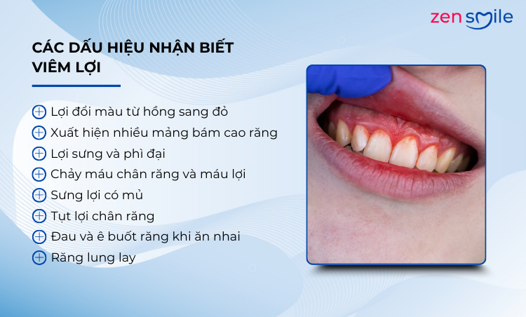 Điều trị viêm lợi mức 1-3 — ảnh 3