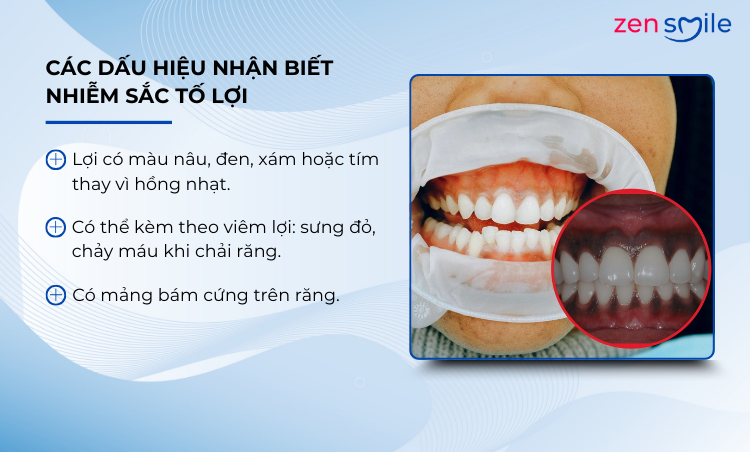 Điều trị nhiễm sắc tố lợi mức 1-3 — ảnh 3
