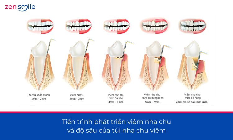Điều trị nha chu không lật vạt — ảnh 3