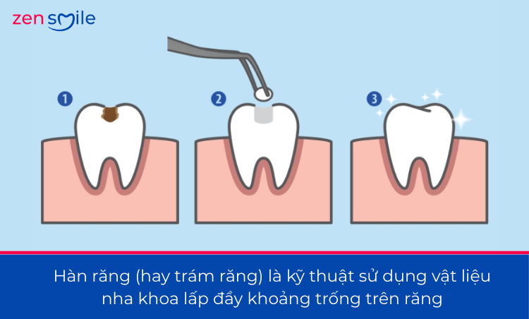 Hàn răng vĩnh viễn (độ 1 – độ 3) — ảnh 2