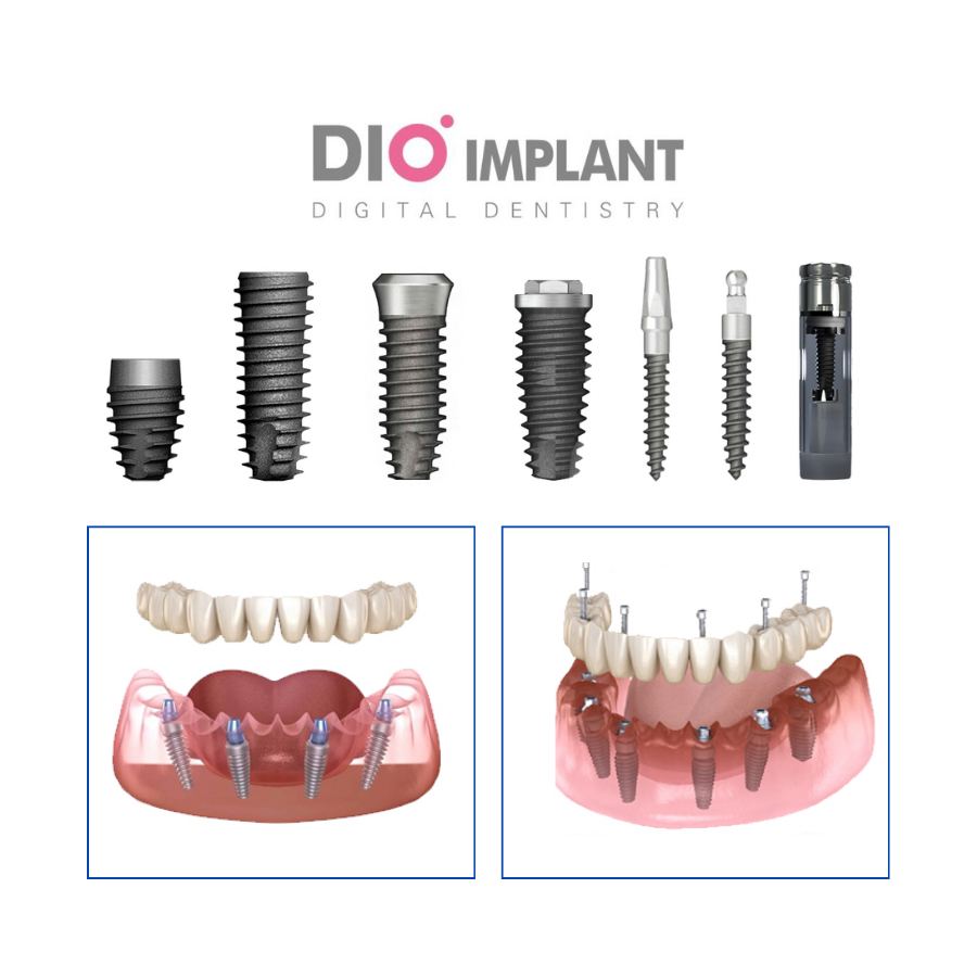 Implant All-on DIO Korea — ảnh 1