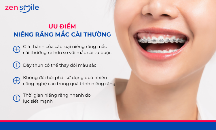 Mắc cài kim loại truyền thống — ảnh 3