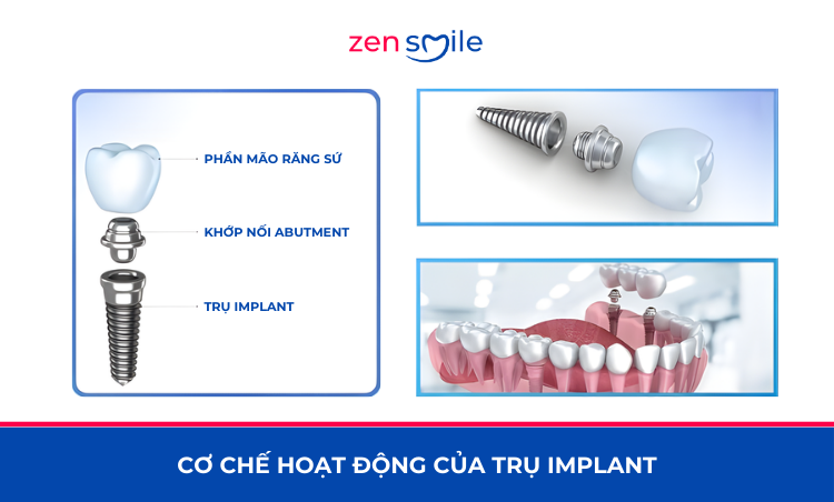 Abutment Customized Sứ (Korea) — ảnh 3