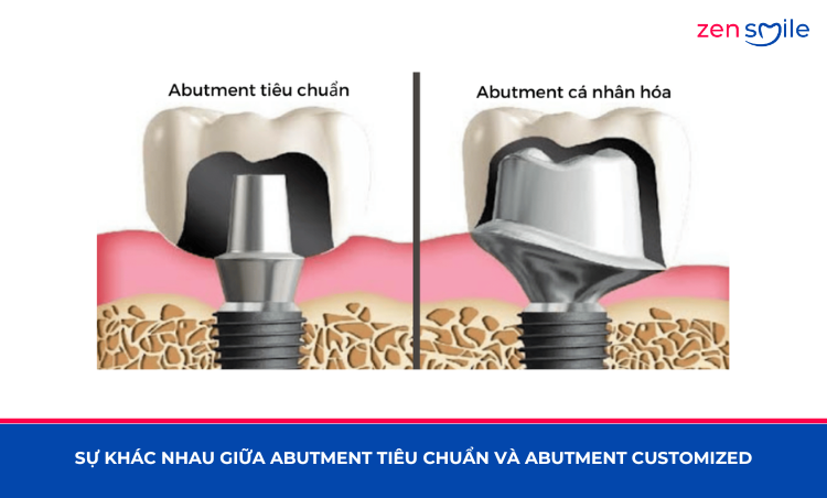 Abutment Customized Sứ (USA) — ảnh 6