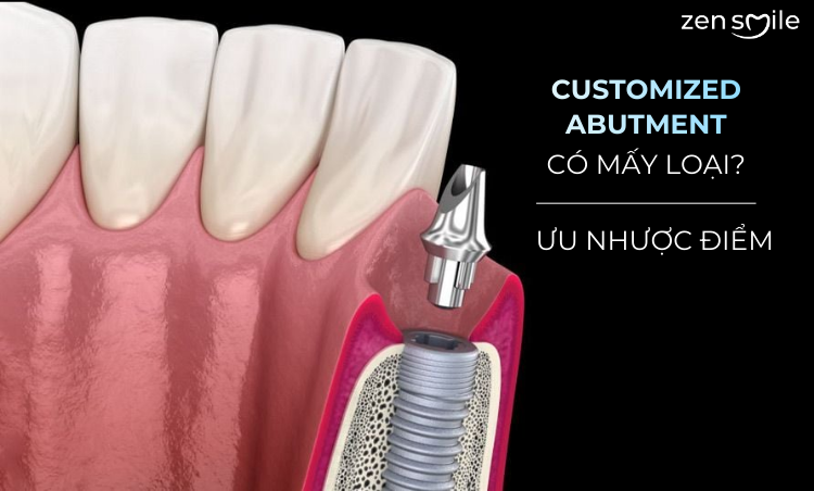 Abutment Customized Sứ (Korea) — ảnh 5