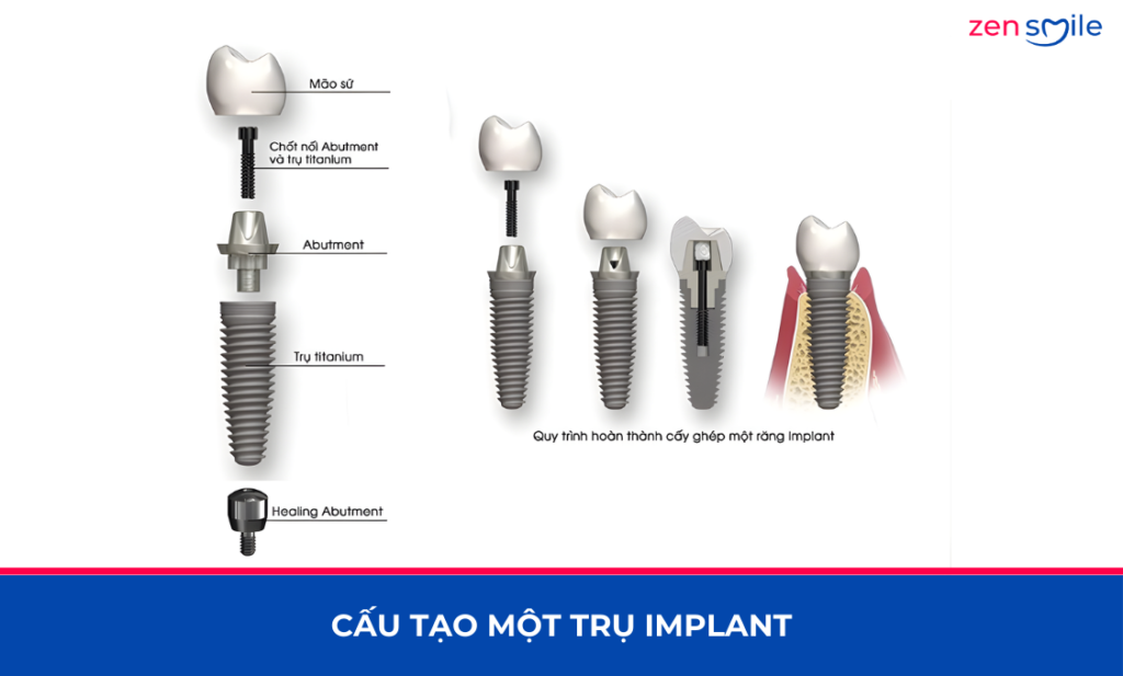 Lấy implant cũ — ảnh 2