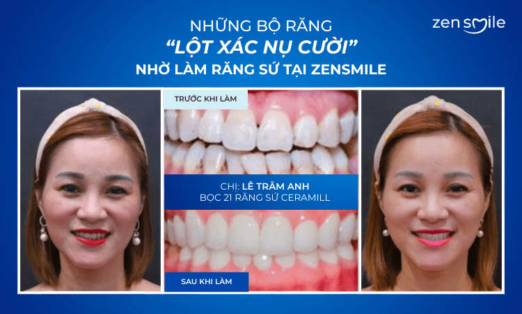 Ca trước – sau tại Nha khoa Zensmile 4