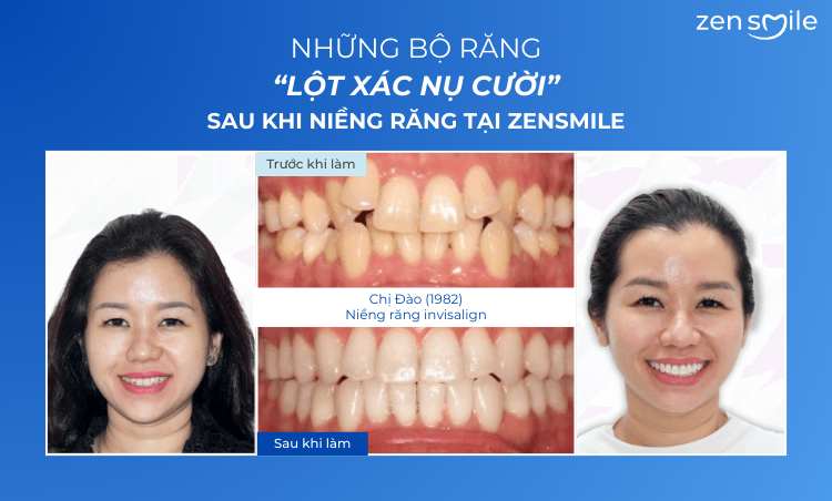 Ca trước – sau tại Nha khoa Zensmile 1
