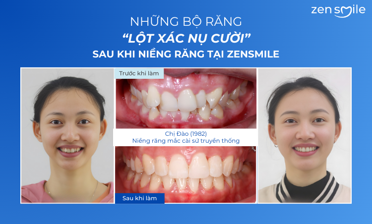 Ca trước – sau tại Nha khoa Zensmile 2